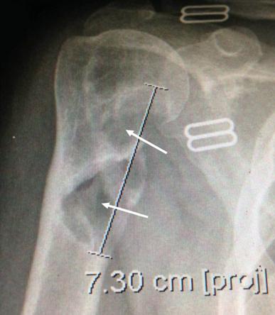 Figure 1: X-ray of the right humerus.