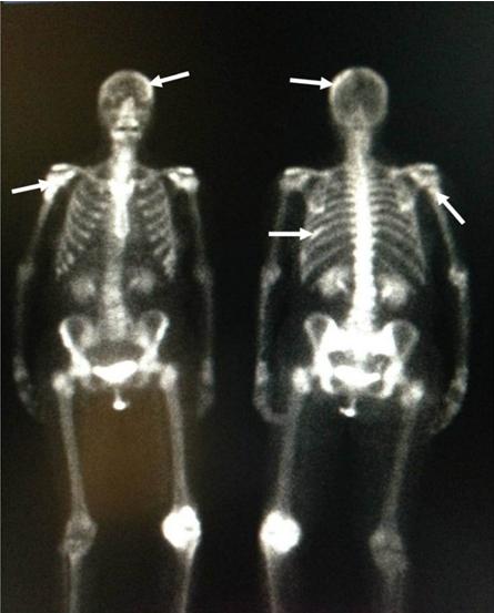Figure 2: Bone scan.