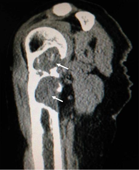 Figure 3: Non contrast CT scan of the right humerus.