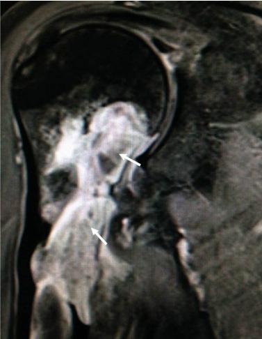 Figure 5: Fat saturated T1-weighted coronal MRI image of the proximal right humerus following IV Gadolinium administration demonstrating enhancing large aggressive soft tissue mass located within the proximal right humeral metaphysis and extending into the visualized portion of the diaphysis, identified by the white arrows.