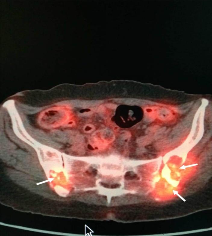 Figure 6: PET/CT scan.