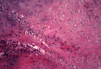 Figure 3: Hyperchromatic nuclei.