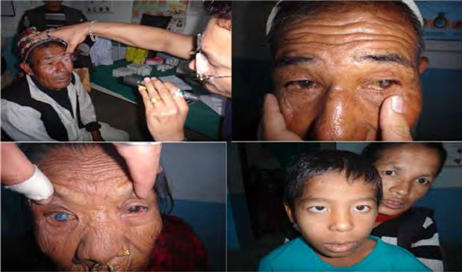 Figure 3: Some ocular findings in the camp.