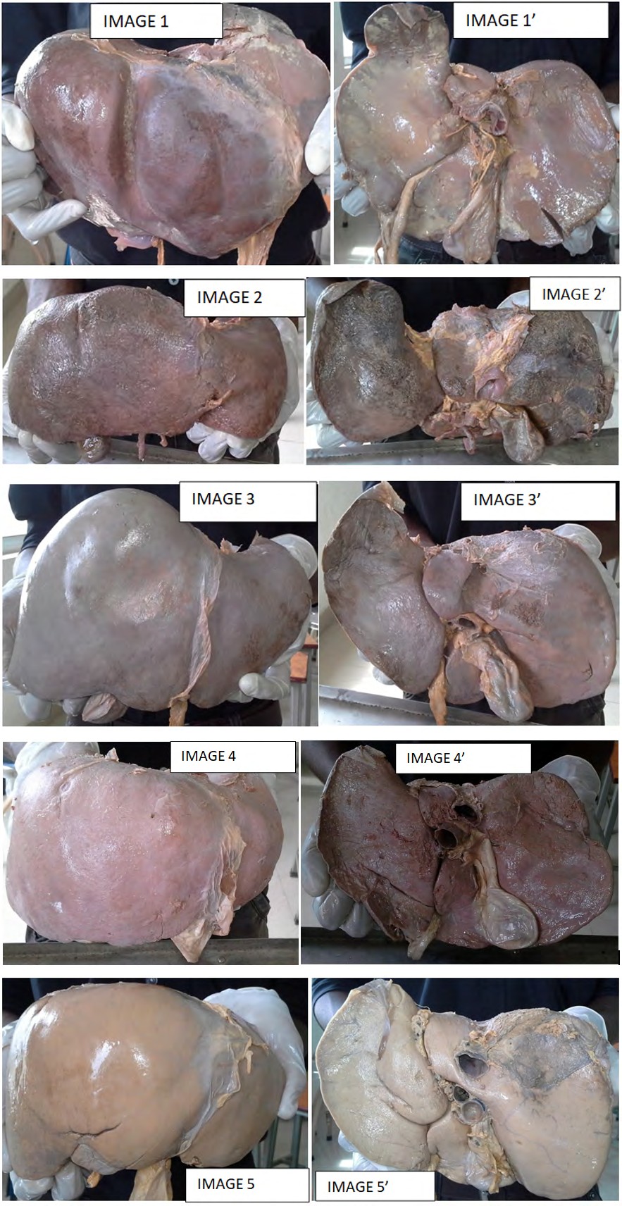 Figure 1: Intrahepatic gall bladder.