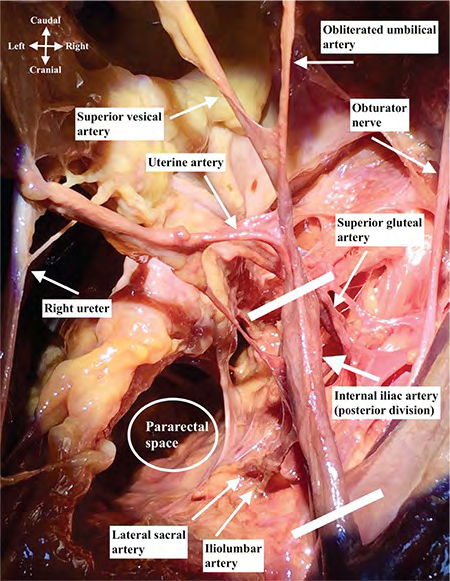 Figure 1: Right internal iliac artery dissection, superior view [7].