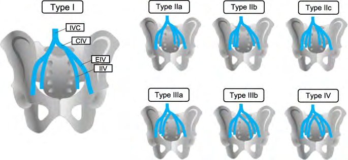 Figure 6: Variations in the branching pattern of the internal iliac vein. IVC, inferior vena cava; CIV, common iliac vein; IIV, internal iliac vein; EIV, external iliac vein [5].