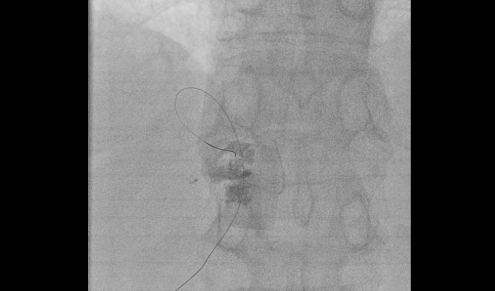 Figure 4: Percutaneous X-ray guided drainage- guidewire ‘lunderquist’.