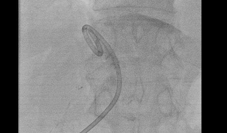 Figure 5: Pigtail F9-catheter drain of the infected fluid /post pus aspiration/.