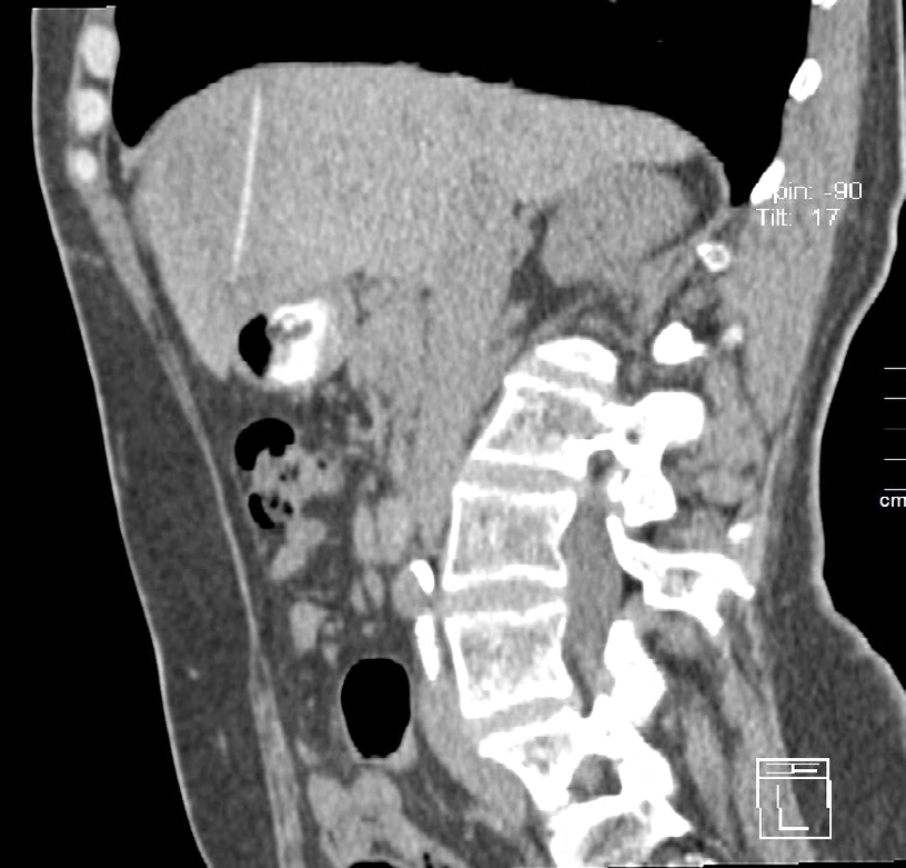 Figure 6: Non cntrast CT after drainage. A hyperdense line- foreign body/suggested fishbone/.