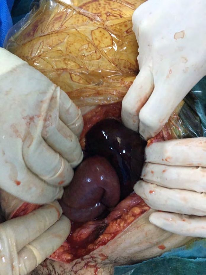 Figure 1: Small intestinal isschemia.