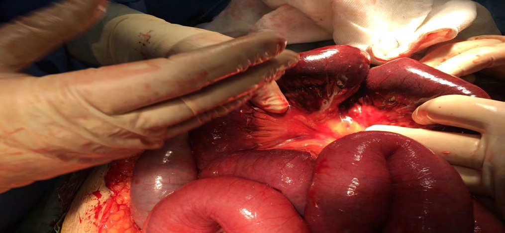Figure 2: Intestinal ischemia and MVT.