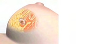 Figure 5: Applicator removed and incision closed.