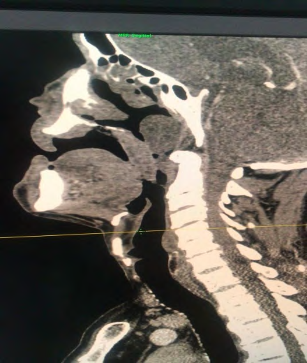 Figure 2: Sagital CT scan showed an ulceration of hard palate mucosa.