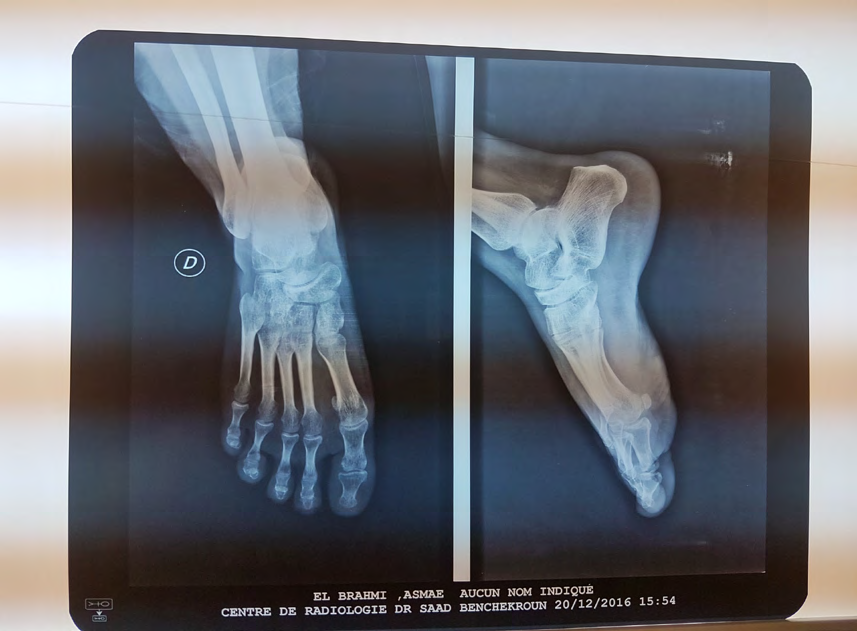 Figure 2: The patient had an X-ray of the limb showing a speckled aspect in the tarsal bones with poorly individualized joint lines and a thickening of the soft tissues facing it.