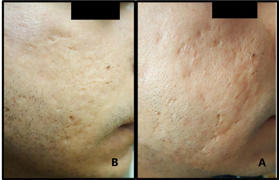 Figure 6: Left side of the same patient (A) before and (B) after treatment, with moderate improvement of acne scars.