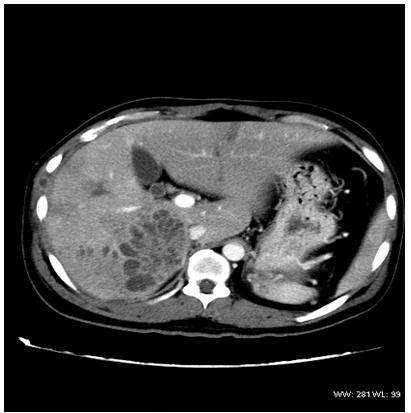 Figure 1: A representative computed tomography of Case 1. The second patient presented with fever, respiratory distress and hypotension. On evaluation, he was found to have lobar pneumonia. For persistent respiratory distress, he required mechanical ventilation, inotropic support and antibiotics (meropenem and targocid). During the course of recovery, he developed septic arthritis involving the left ankle joint. His general condition gradually improved with three weeks of intravenous antibiotics. He was discharged on oral ciprofloxacin and doxycycline for a period of eight weeks. He has been doing well on follow up. The third patient presented with high grade fever and ultrasound scan of the abdomen showed a 3x 3 cm splenic abscess. After initial response to ceftazidime, he developed pain and swelling over the right ankle. He was started on meropenem which was continued for four weeks. He was discharged on oral cotrimoxazole and is asymptomatic on follow up. The clinical features, laboratory parameters and radiological findings are summarised in (Table 1).