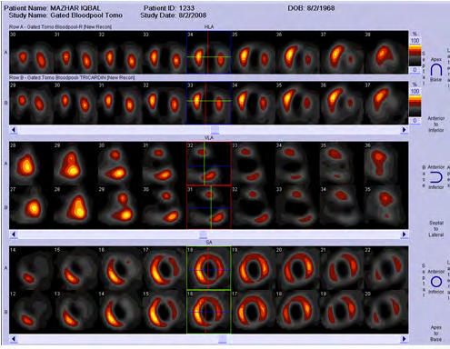 Figure 1: Absence of Viable Myocardium in SMRE (study 2) as well as NO3 (study 1).