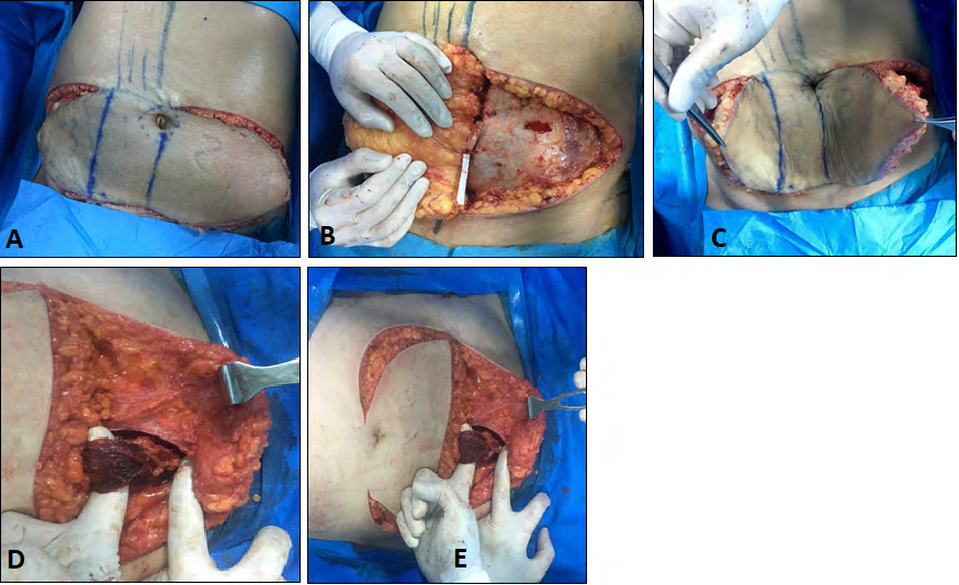 Figure 2: A. Skin incision. B. zone II and zone IV elevation, showing perforator of DIEA. C. Skin paddles. D,E. lower portion of Rectus muscle.