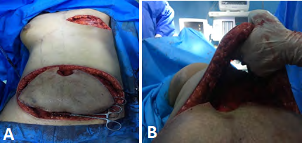 Figure 6: (A,B) anterior and lateral views 3 weeks post op. (C,D) 3 months post op.(E,F) 2 views after reduction of contralateral breast.