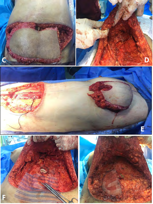 Figure 7: A, B, C 3 views for patient with left mastectomy since 1 year. D, E, on table results.