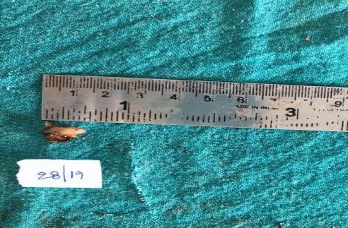 Figure 4: Incisional biopsy done in relation to the labial vestibular region and sutures placed.