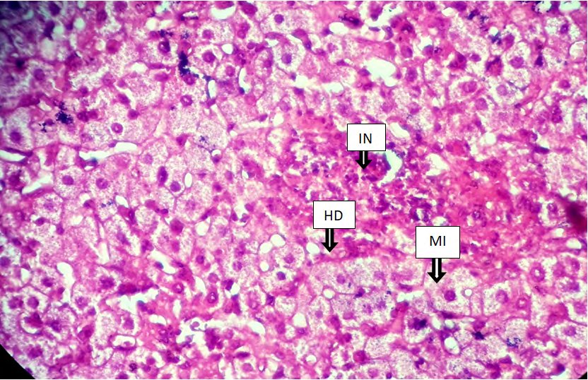 Figure 6: Cross histological section of the liver tissue from castrated male mice showing Hydropic degeneration (HD), Micro vesicular steatosis (MI) with inflammatory cellular of lymphocyte (IN), (X400)