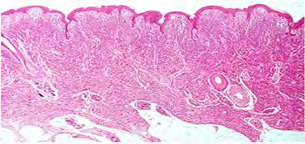 Figure 7: Linear and whorled nevoid hypermelanosis in 8 months old infant.