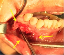 Figure 4: The formation of bone in the mandibular branch (yellow arrow), persistence of the lesion (red arrows) and titanium mesh (green arrow) are observed.