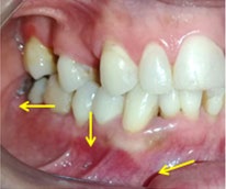 Figure 5: Curtteage of mandibular body injury and removal of titanium mesh (yellow arrows).