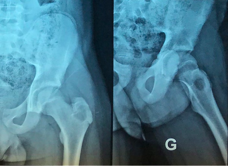 Figure 1: Frontal and oblique X-rays of the left hip showing a lacunar image at the level of the left greater trochanter with a geodic aspect.