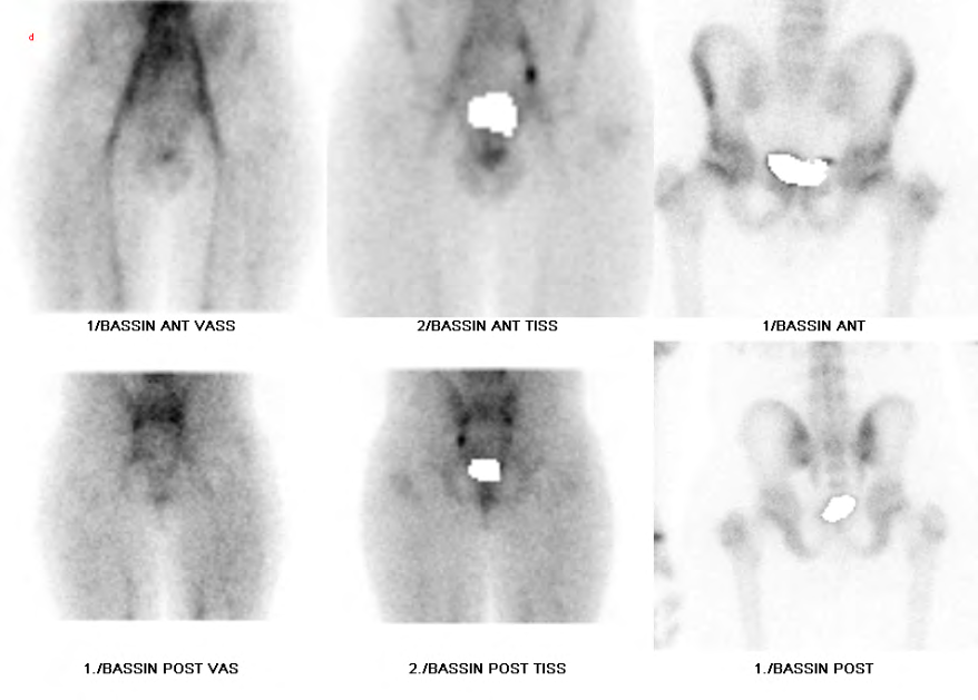 Figure 3: Bone scintigraphy showing at the early stage (tissue) a slight hyperemia in the left hip and at the late stage an asymmetry of bone fixation opposite both two trochanters with a hyperfixation the left side.