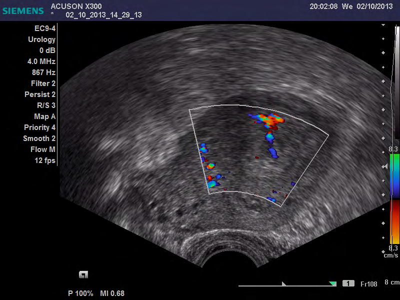 Figure 2: Endometrial thickness measures 15 mm, minimal endometrial blood flow (IETA score2), scattered vessel pattern, homogenous endometrium, regular endometrial myometrial junction, linear endometrial midline. Histopathology revealed endometrial hyperplasia.