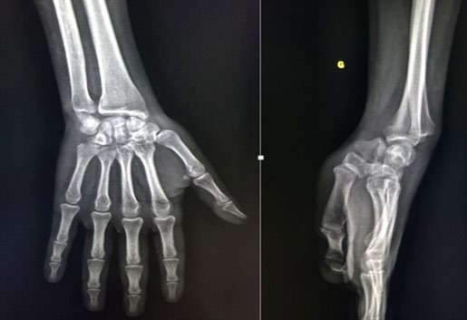 Figure 1: Preoperative radiographs of the left wrist, face and profile.