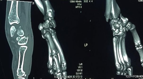 Figure 2: CT aspect of the fracture dislocation antelunar trans scapho capital.