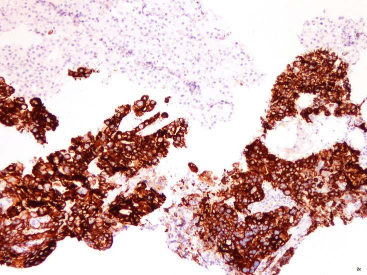 Figure 2: ** Hematoxylin and eosin stained slides at medium (a) and high magnification (b) show the presence of a fragment of unremarkable liver (top left hand corner) admixed with fragments of a poorly differentiated malignant neoplasm composed of neoplastic cells forming ill-defined glands associated with central necrosis*. Immunohistochemically stained slides with antibodies to CK20 and HepPar-1 shows diffuse strong positive homogenous staining with CK20 (c) and no expression of HepPar-1 in the neoplastic cells at the bottom of the picture panel (d) Reverse pattern of staining is seen in the adjacent fragment of uninvolved liver at the top of the picture panel.