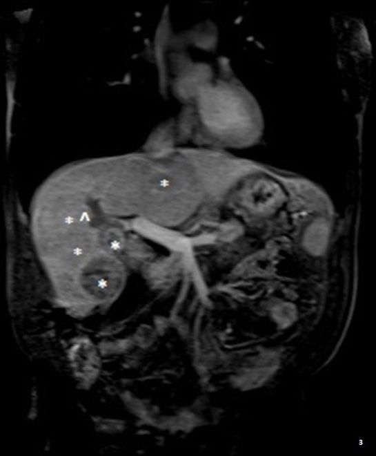 Figure 3: MRI Follow-up 2months. MRI liver with contrast shows several [4-5] heterogeneous solid hepatic masses* within the right hepatic lobe associated with thrombus of the right portal vein^ and smaller early enhancing foci in the left hepatic lobe with signal and enhancement characteristics concerning for multifocal hepatocellular carcinoma.