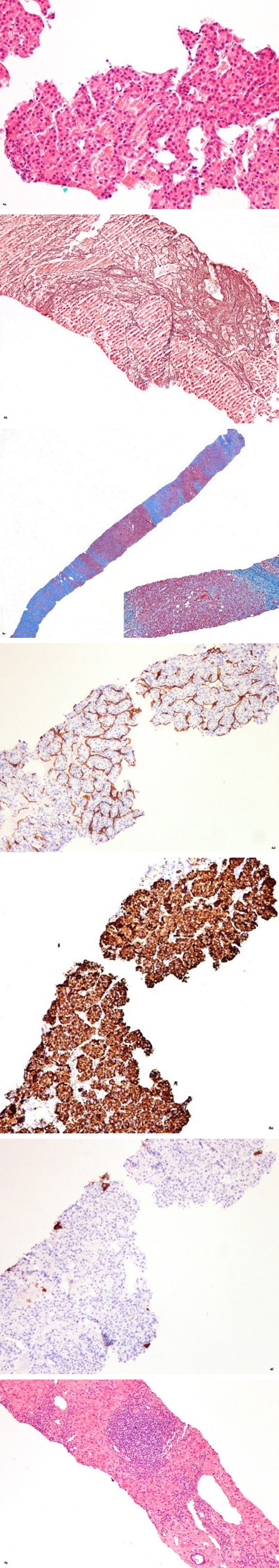 Figure 4: ** Hematoxylin and eosin stained slides at medium magnification showing atypical hepatocytes arranged in 3-4 cell thickened plates that focally forms pseudo glands (a) with loss of normal staining pattern with reticulin (b) in keeping with moderately well differentiated hepatocellular carcinoma arising in the background of a densely fibrotic liver as highlighted by intense blue staining of the collagen with Masons trichrome stain, inset with higher magnification (c). Immunohistochemically stained slides with antibodies to CD 34 demonstrates the typical sinusoidal capillarization of the neoplastic liver cells (d). Staining with HepPar-1 antibody is expressed in the neoplastic cells € while staining with CK20 antibodies is negative (f). Hematoxylin and eosin stained slides of the non-neoplastic liver parenchyma at low magnification (g) shows mild increased portal inflammation*with mild steatosis^, while Perl’s stained slides show mild increased iron deposition as blue granules (h).