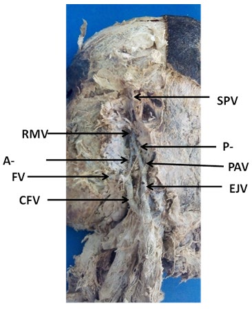 Figure 1: ** Left side of the head & neck showing a very short trunk of the retromandibular vein, which immediately divided into anterior and posterior divisions. The anterior division joined with the facial vein to form a common facial vein which directly drained into external jugular vein instead of internal jugular vein.