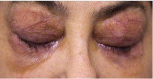 Figure 3: Thickening of the skin on the body and chest- amyloids under the skin.