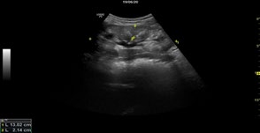 Figure 7: Medullary nephrocalcinosis.
