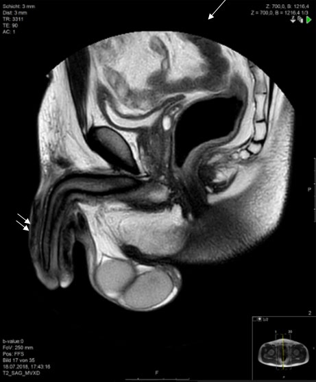 Figure 3: ** (a,b): T1 w SE axial and sagittal with Fat-suppression and contrast enhanced sequence demonstrated diffused enhancement of the peri-cavernosal soft tissue of the penis with small delineated non-enhancing areas probably micro- abscesses. Increased vascularity (arrow) around the penis as sign of profuse inflammatory.
