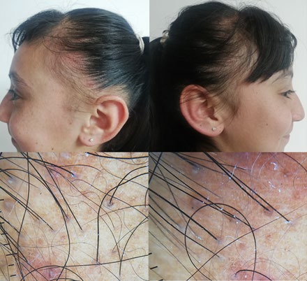 Figure 2: Girl of 16 years old, with alopecic patches located in bitemporal regions, we can see erythema and perifolcular papules. In the tricoscopy we can observe vellous hair, Black dots, peripheral marron pigmentation and hemorragic crust. Findings suggestive of traction folliculitis.