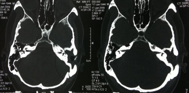Figure 1: Pure tone audiometry depicting a mixed hearing loss in the left ear.