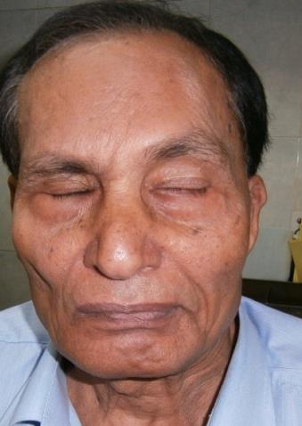 Figure 3: Post –operative healed cavity (a) with grade 2 facial nerve palsy (b)
