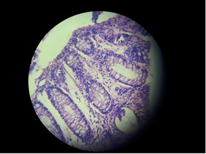 Figure 4: Post-operative picture of the patient with residual corneal opacity (Right side).