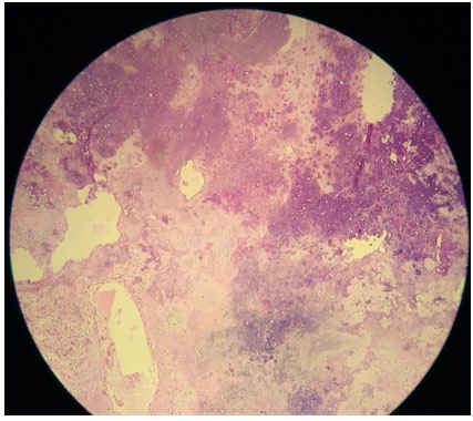 Figure 4: Microscopic examination showing anastomosing trabeculae of osteoid and woven bone, rimmed by single layer of benign activated osteoblasts, numerous osteoclasts, and loose fibrovascular stroma between bone trabeculae with cartilaginous component.