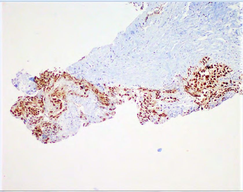 Figure 4: Strong nuclear staining with OCT3/4 (X 100).