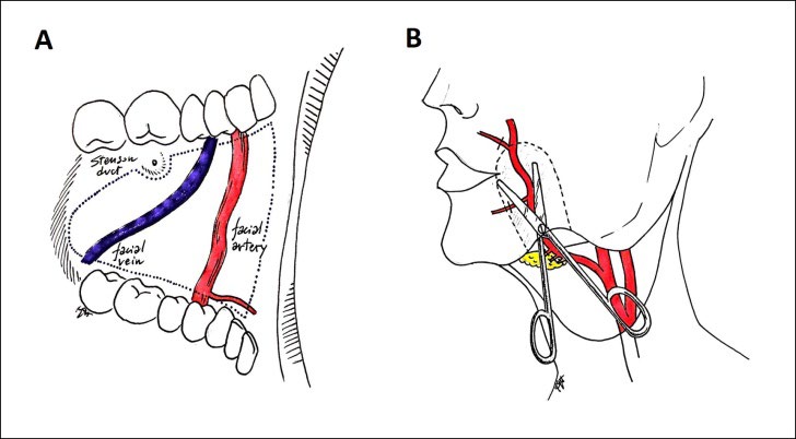 Figure 1: A. Intraoral drawing of the flap according to the anatomic points described in the text. B. The dotted line represents the intraoral flap based on the facial artery that is dissected at the level of the scissor.