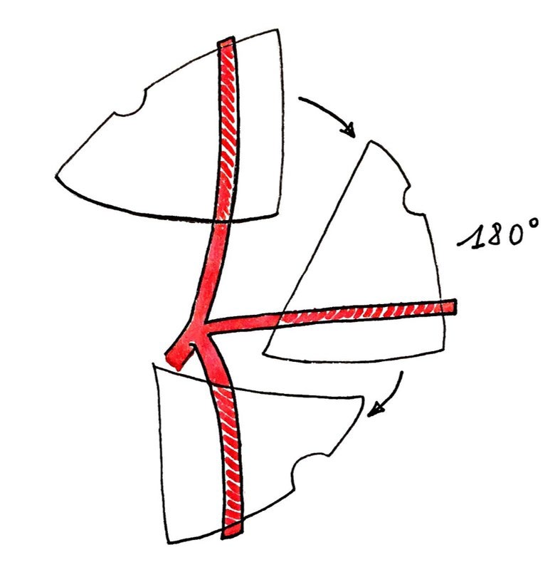 Figure 3: A. Squamous cell carcinoma of the lateral border of the tongue (T2). B. The defect after resection.