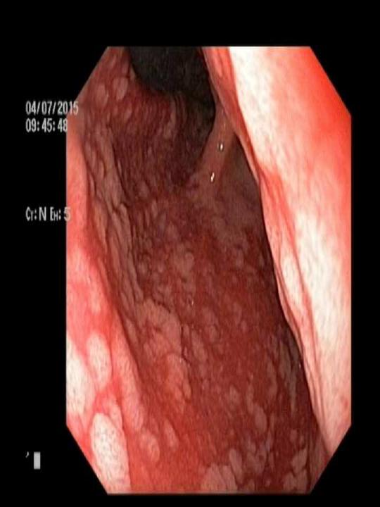 Figure 2: Endoscopic polypoid appearance in proximal body.